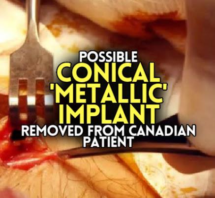 Possible CONICAL 'METALLIC' IMPLANT Removed Canadian Patient
